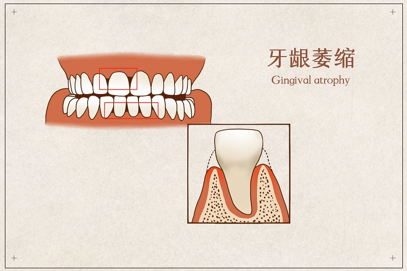 摄图网_401804075_banner_牙龈萎缩医疗插画（企业商用）.jpg